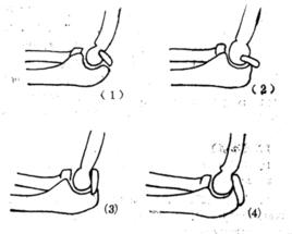 骨阻滯術 骨阻滯術
