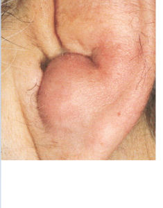 耳廓假性囊腫