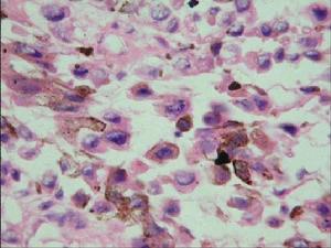 原發性食管惡性黑色素瘤