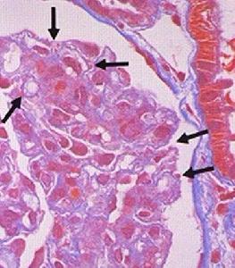 駝峰性腎小球腎炎