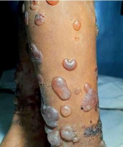 大皰性類天皰瘡