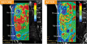 經過治療後，腫瘤中的供血量明顯降低