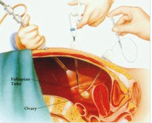 宮腹腔鏡手術