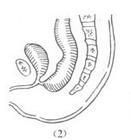 先天性直腸與周圍臟器瘺 先天性直腸與周圍臟器瘺