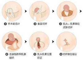 巨乳縮小 巨乳縮小