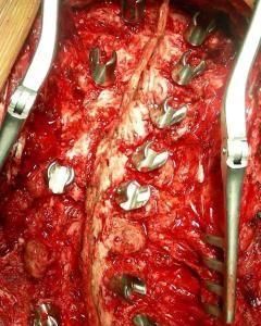 脊柱側彎手術 脊柱側彎手術