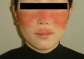 蝶形紅斑 蝶形紅斑