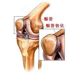 膝關節髕骨軟化 膝關節髕骨軟化
