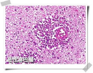 組織細胞壞死性淋巴結炎 組織細胞壞死性淋巴結炎