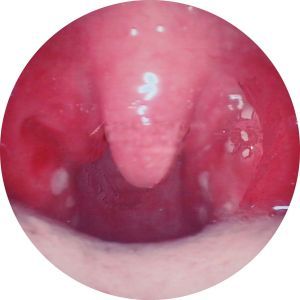 急性化膿性扁桃體炎 急性化膿性扁桃體炎