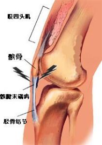 跳躍者膝 跳躍者膝