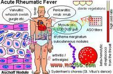 急進性腎炎 急進性腎炎
