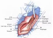 示意圖2:切開隔肌，探查腹腔臟器有無轉移