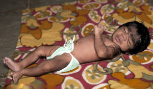 出生22天的狼人基因綜合徵患者