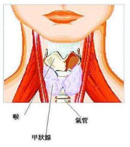 放射性甲狀腺炎