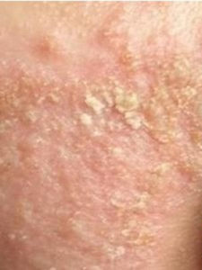 脂溢性皮炎 脂溢性皮炎