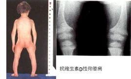 維生素D依賴性佝僂病 維生素D依賴性佝僂病