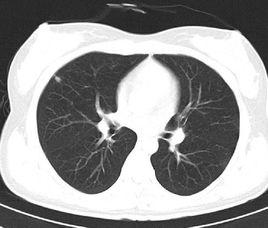 胸部CT 胸部CT
