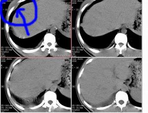 何杰金氏淋巴瘤