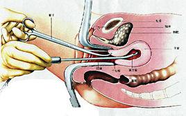 雙腔減壓人流術