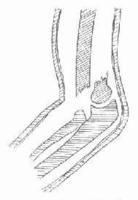 肱骨髁骨折 肱骨髁骨折
