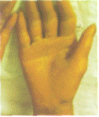 迴旋形線狀魚鱗病