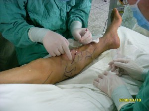 單純性下肢靜脈曲張