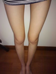 O型腿