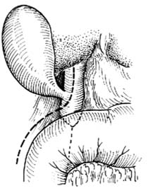 先天性膽管囊狀擴張症