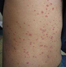 小兒牛皮癬 小兒牛皮癬