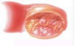 卵巢黃素瘤