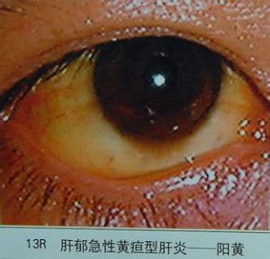 肝鬱急性黃疸肝炎