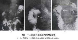 十二指腸重複畸形
