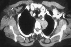 外源性過敏性肺泡炎