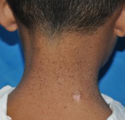 著色性乾皮病 著色性乾皮病