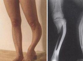 肢體短縮畸形 肢體短縮畸形