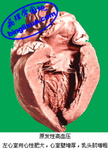 良性高血壓