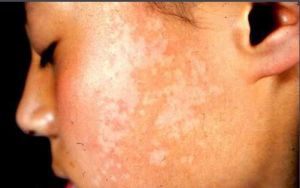 貧血性痣 貧血性痣