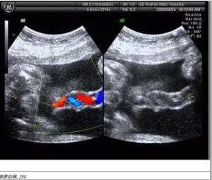 單臍動脈 單臍動脈