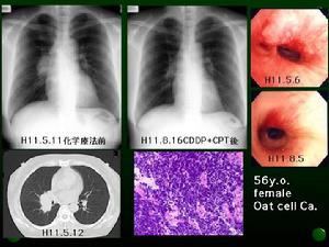 社會獲得性肺炎