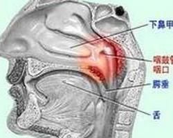 咽鼓管異常開放