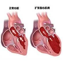 繼發於全身疾病的特異性心肌病