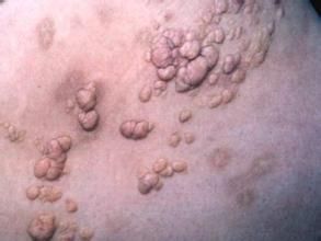 腹膜後脂肪瘤 腹膜後脂肪瘤