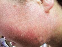 塗抹外敷藥膏誘發的依賴性皮炎