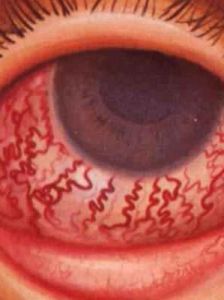 開角型青光眼 開角型青光眼