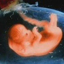 胎兒畸形 胎兒畸形