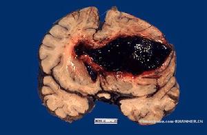 硬腦膜外血腫