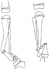 先天性脛骨假關節