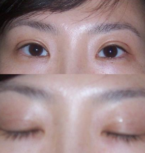 點壓雙眼皮 點壓雙眼皮