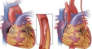 冠狀動脈旁路搭橋術 冠狀動脈旁路搭橋術